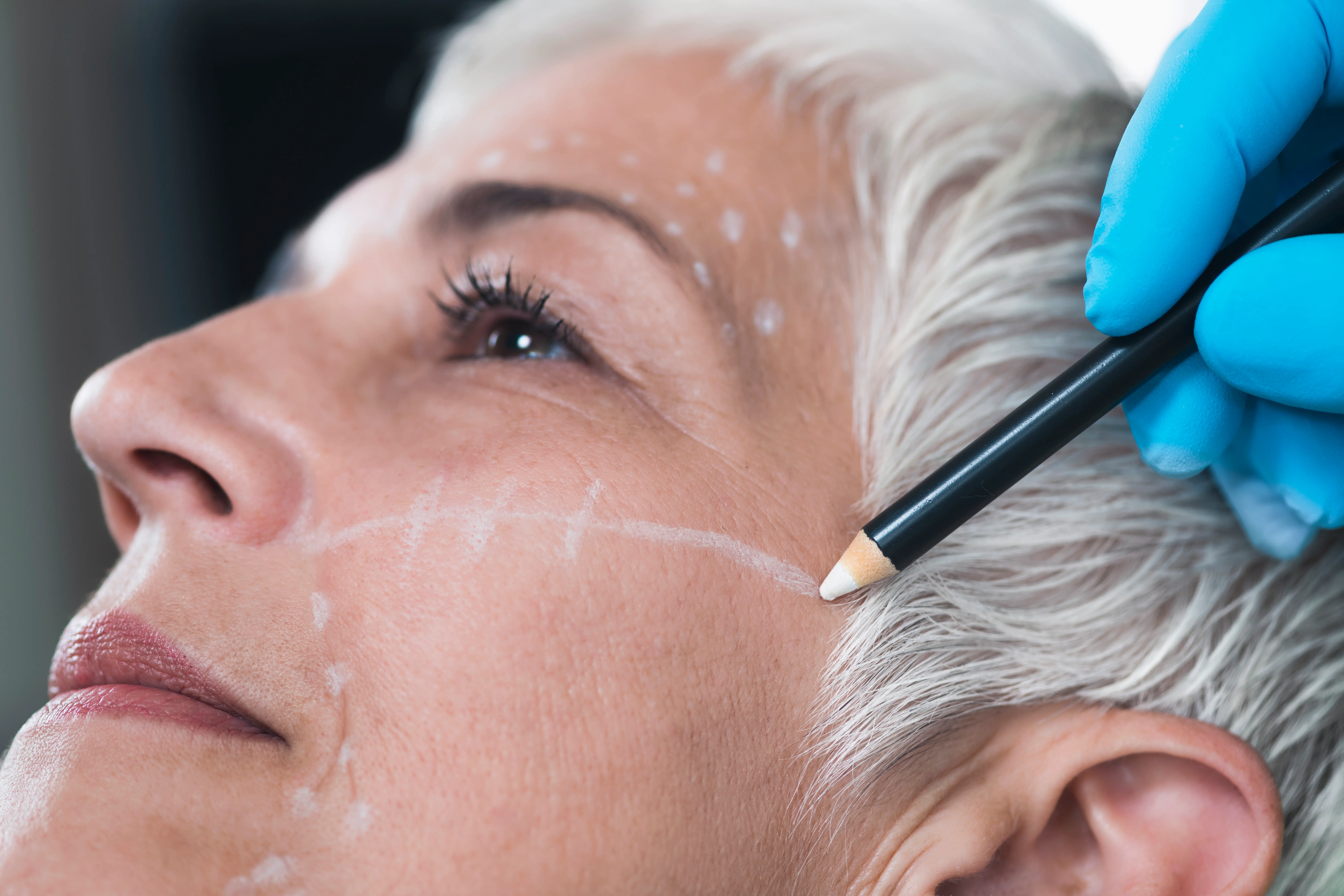 Traitement des rides