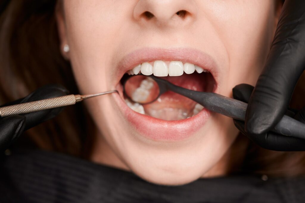 Dentiste en train d’effectuer une extraction de dent de sagesse
